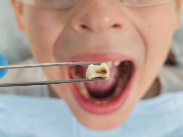 Best Emergency Dental Care for Abscessed Tooth in New Pek, IN